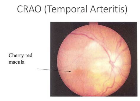 Retinal Disorders Flashcards | Quizlet