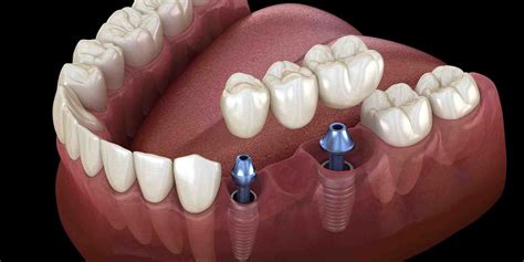 What do dental implants look like - Dental News Network