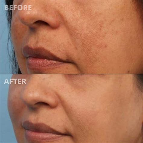 Hollywood Spectra Laser — La Belle Peau Skincare Clinic