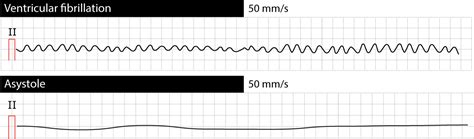Ventricular fibrillation, pulseless electrical activity and sudden cardiac arrest – ECG learning