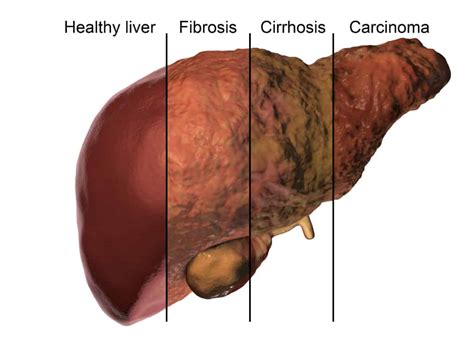 10 BENEFITS OF A HEALTHY LIVER (AND HOW TO BOOST YOUR LIVER HEALTH!) - Unlimited Health