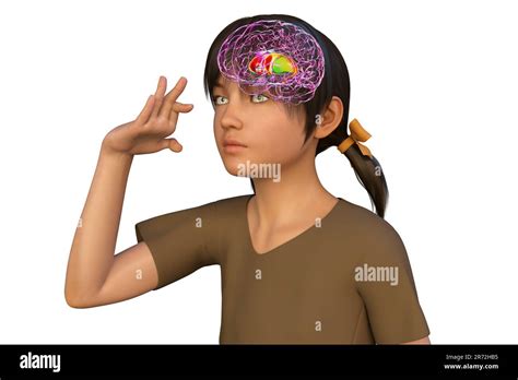 A boy with Sydenham's chorea and involuntary movements of a hand, computer illustration ...