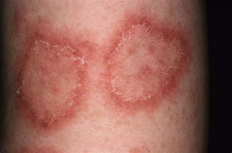 15 Skin Conditions: Pictures, Symptoms, Treatment