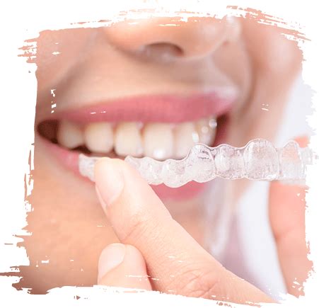 Invisalign Braces Frequently Asked Questions [FAQS]