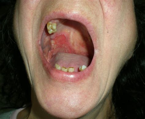 Oral Squamous Cell Carcinoma Cheek