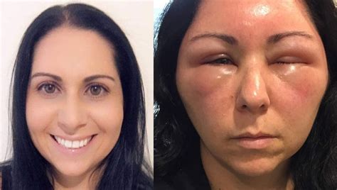 Woman's allergic reaction to hair dye causes severe swelling in face, head | FOX 5 Atlanta