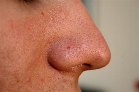 File:Nose with Blackhead 2009.jpg - Wikimedia Commons