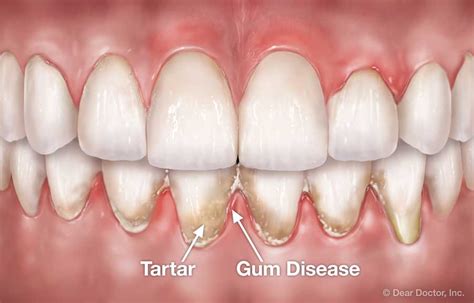 Periodontal Flap Surgery | Coastal Periodontics & Implant Dentistry ...