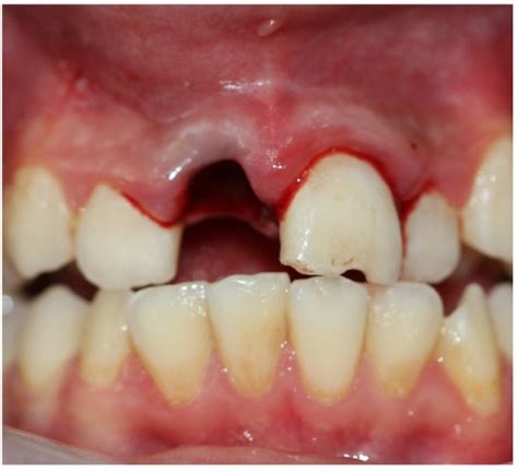 Dental avulsion - WikEM