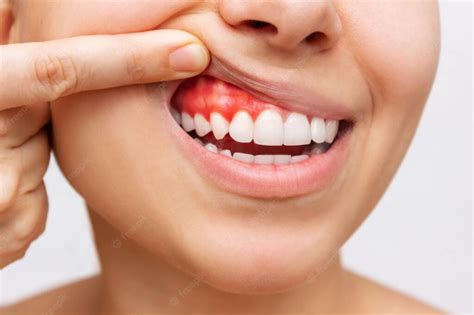 Bleeding Gums: Causes and Home Remedies - Express Dentist