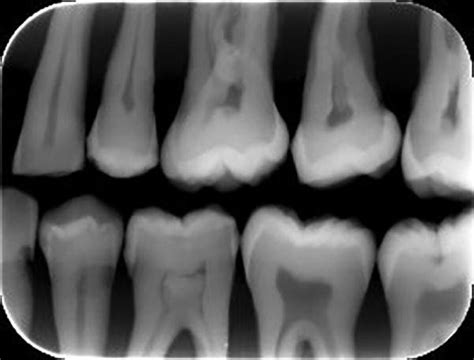 Two tooth blocks in occlusion, using a bitewing film holder, a 1.0 cm ...