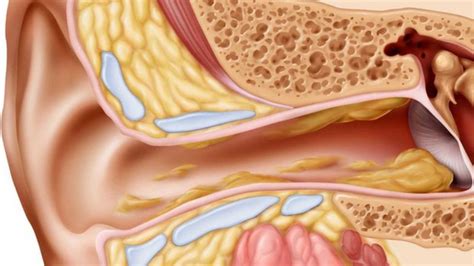 How to dissolve my ear wax fast?