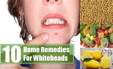 10 Home Remedies For Whiteheads | Search Home Remedy