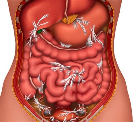 Bowel Obstruction