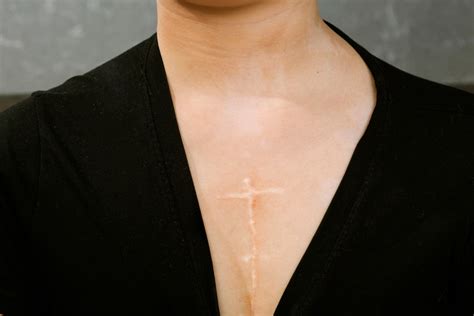 Open Heart Surgery Scar Healing: How to care scars | Miami, FL