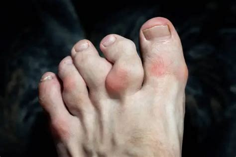 Arthritis in Toes - Types, Symptoms, Treatment, Exercise