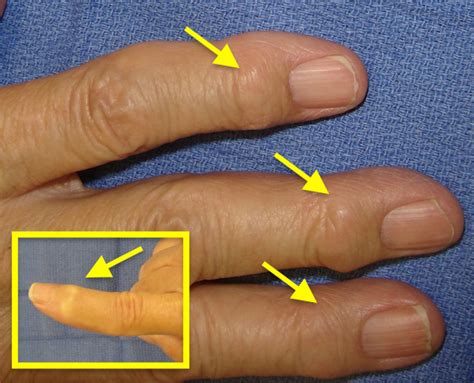 Osteoarthritis Nodules On Fingers