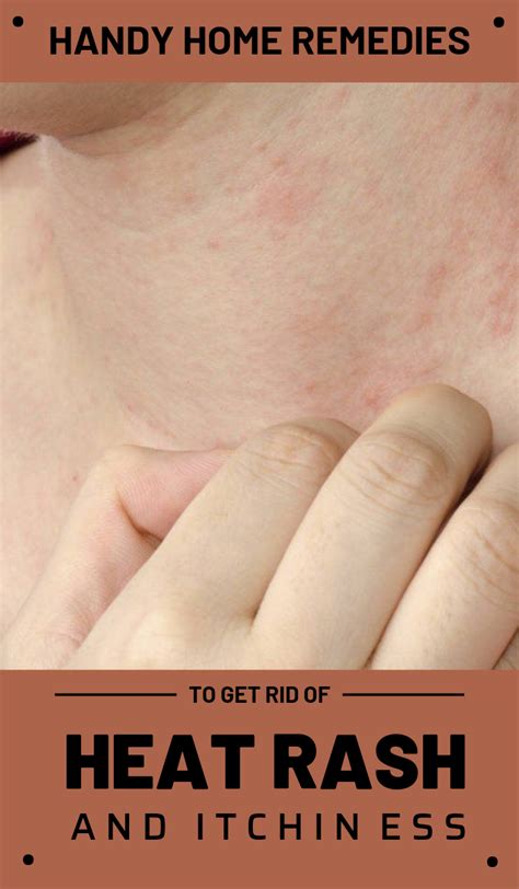 Severe Heat Rash Treatment - HEATFAG