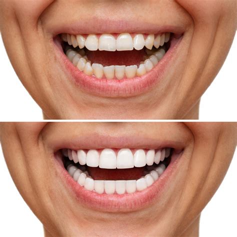 Affordable Teeth Whitening in Seawoods | Smilekraft Dental Clinic