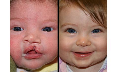 Primary Cleft Lip & Nasal Reconstruction Gallery | St. Louis Children's ...