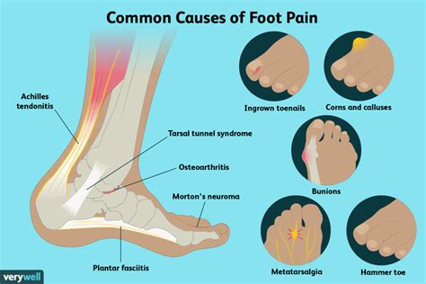 Foot Pain: Causes, Treatment, and When to See a Doctor