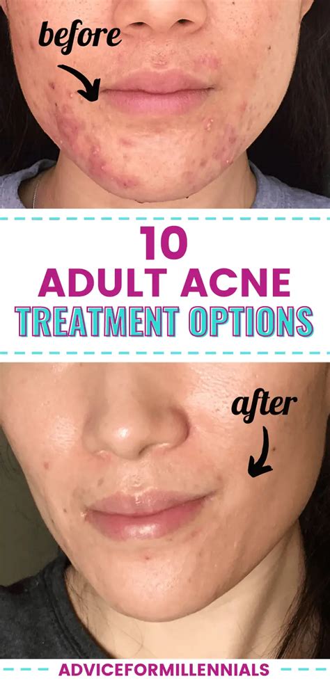 10 Adult Acne Treatment Options You (Probably) Haven't Tried Yet - Advice for Millennials