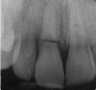 Dentoalveolar Fractures