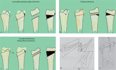 53 Distal Radius Osteotomy for Malunion: Dorsal Approach | Plastic Surgery Key