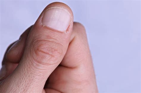 Splitting Nails (Onychoschizia): Causes and Treatment Tips