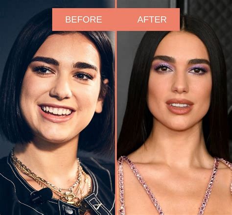 Dua Lipa Nose Job - Did She Underwent Surgery?