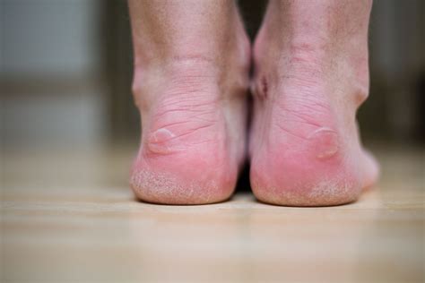 Blisters On Big Toe From Soccer Cleats - Design Talk