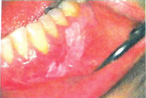 Leukoplakia is a white plaque or patch without any clinical or... | Download Scientific Diagram