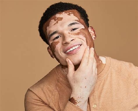 Curtis McDaniel’s journey from a shy teenager to a bold Vitiligo model ...