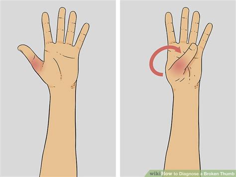 How to Diagnose a Broken Thumb: 15 Steps (with Pictures) - wikiHow