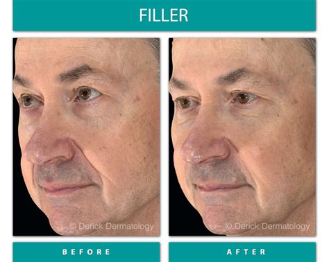 Before & After Gallery - Filler - Derick Dermatology
