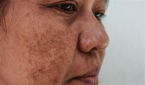 RACGP - Melasma