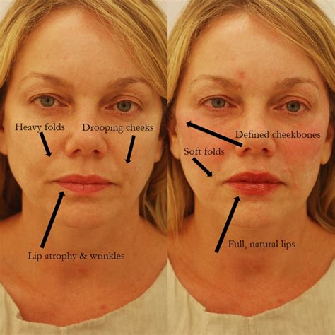 What is a Liquid Facelift? The New Modern Facelift Procedure — Lara ...