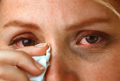 symptoms of different itchy eyes with pictures - Find All Eye Care Tips