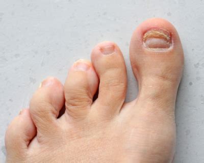 Toenail Injuries | Podiatrists, Foot and Ankle Specialists & Diabetic Foot Care Specialists ...