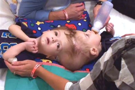Conjoined Twin Boys Successfully Separated in Rare Surgery.letu
