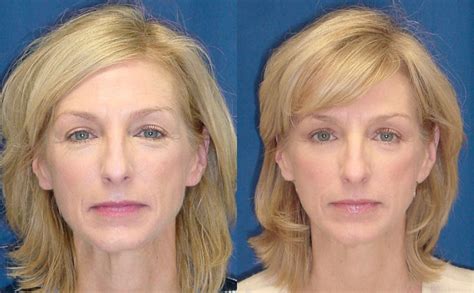 Before & After Eyelid surgery for drooping eyelid - Ricardo L. Rodriguez MD, Baltimore