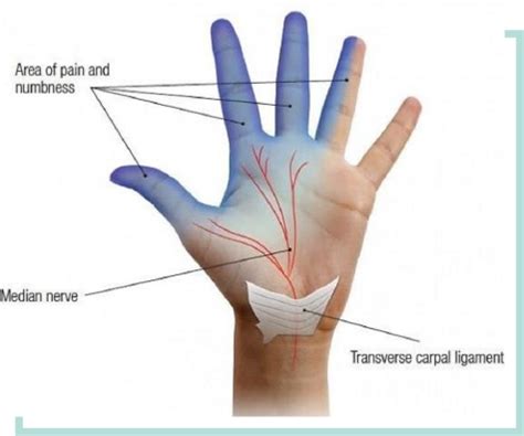 Carpal Tunnel Syndrome - AA Active Physio Centre