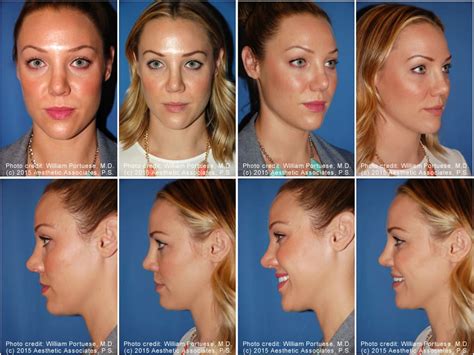 Saddle Nose Before and After Photo Gallery - Nose Surgery Photos
