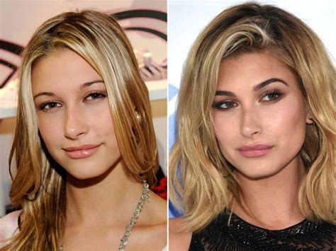 Hailey Bieber, Before and After | Celebrity plastic surgery, Laser hair, Cosmetic surgery