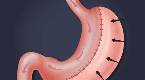 Gastric Sleeve Revision | Cost, Success Rate, Before & After - The Silhouette Clinic