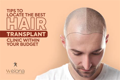 Tips to Locate the Best Hair Transplant Clinic within Your Budget