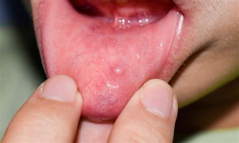 Bump inside lip: Symptom, Causes & Treatments | Local Dentist