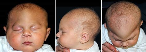 Craniosynostosis causes, symptoms, treatment & craniosynostosis surgery