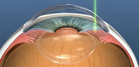 Laser Peripheral Iridotomy - Treat Angle-Closure Glaucoma | Dr Nathan Kerr