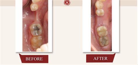 Bone Grafting For Dental Implant - French Dental Services - Dubai - Dr ...